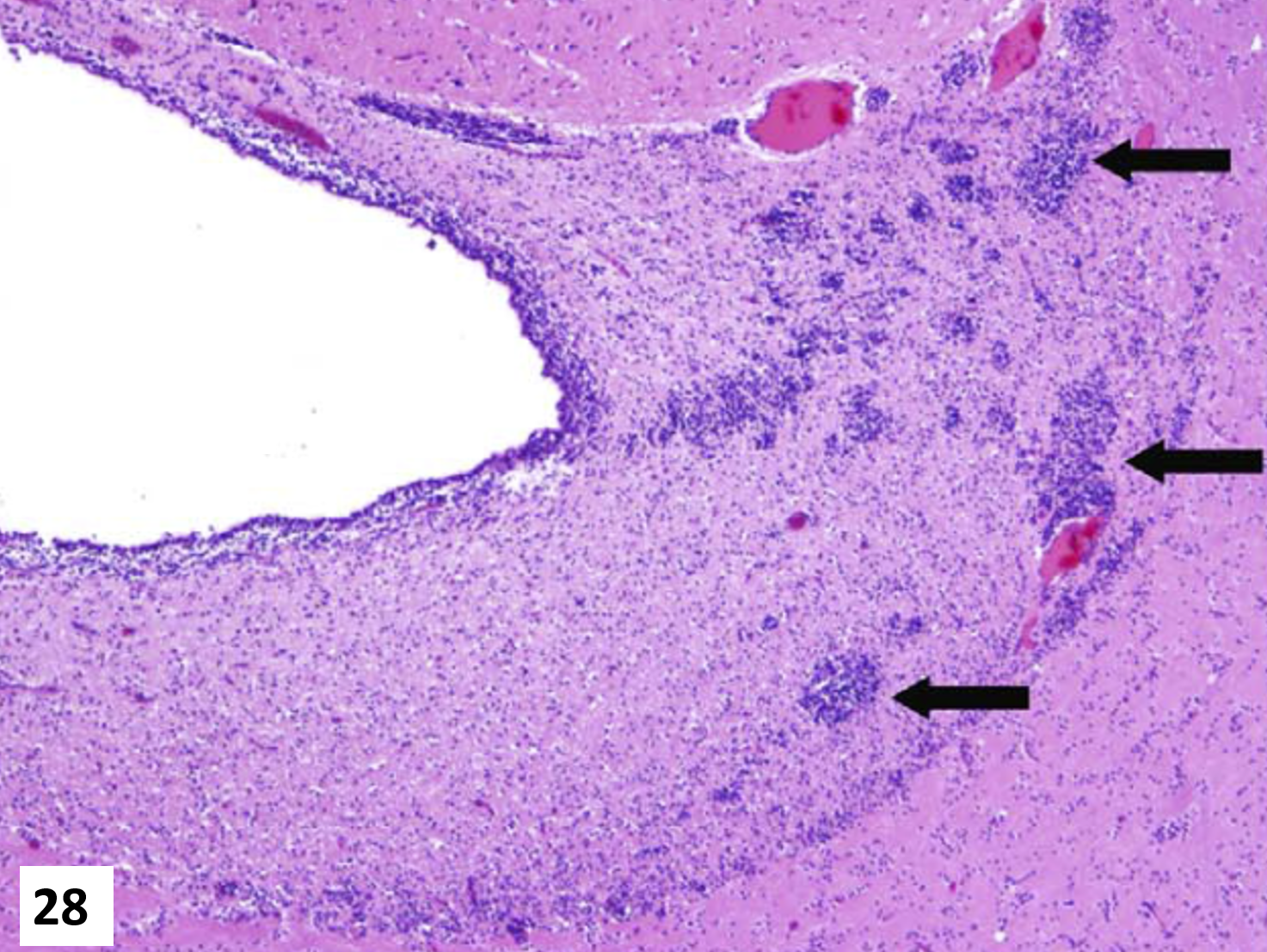 <p>28. Tissue from a cat.<span>&nbsp; </span>What are the arrows pointing to?</p><p class="MsoListParagraphCxSpFirst"><span>a.</span><span style="font-size: 7pt; font-family: &quot;Times New Roman&quot;">&nbsp;&nbsp;&nbsp;&nbsp; </span><span>Germinal cells arranged in islands of Calleja</span></p><p class="MsoListParagraphCxSpMiddle"><span>b.</span><span style="font-size: 7pt; font-family: &quot;Times New Roman&quot;">&nbsp;&nbsp;&nbsp;&nbsp; </span>Migrating precursor cells of the external granular layer of the developing cerebellum</p><p class="MsoListParagraphCxSpMiddle"><span>c.</span><span style="font-size: 7pt; font-family: &quot;Times New Roman&quot;">&nbsp;&nbsp;&nbsp;&nbsp; </span>The blastemal component of a neuroblastoma</p><p class="MsoListParagraphCxSpMiddle"><span>d.</span><span style="font-size: 7pt; font-family: &quot;Times New Roman&quot;">&nbsp;&nbsp;&nbsp;&nbsp; </span>Subventricular and perivascular mononuclear inflammation</p><p class="MsoListParagraphCxSpLast"><span>e.</span><span style="font-size: 7pt; font-family: &quot;Times New Roman&quot;">&nbsp;&nbsp;&nbsp;&nbsp; </span>Microgliosis</p>