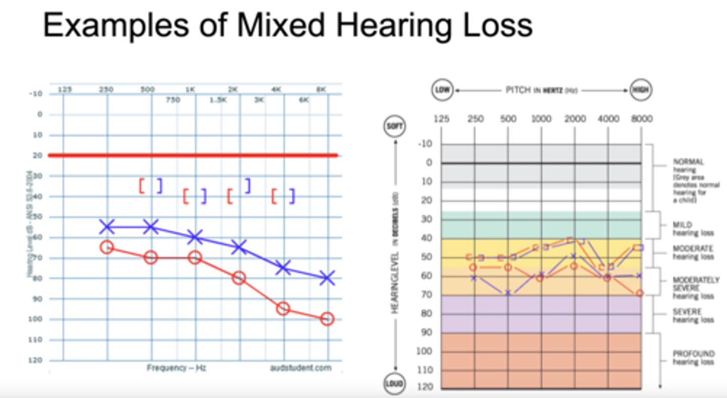 <p>Hearing loss originates from the outer or middle ear AND the inner ear or auditory nerve.</p><p>Audiogram: Air conduction loss, bone conduction loss, and air-bone gap greater than 10 dB.</p>