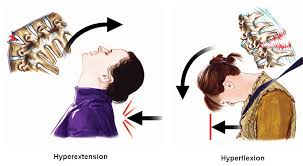 <p>___ refers to excessive flexion(stretching a body part inwards), while ___ refers to excessive extension(stretching a body part outwards)</p>