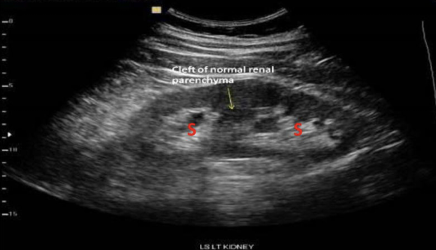 <p>Which congenital varient is this showing?</p>
