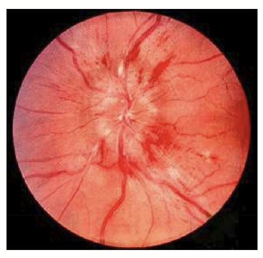 <p>When there is bilateral swelling of the optic nerve head (not papilledema) causing: Reduced vision, eye pain, flame-shaped hemorrhages, and headaches. </p>
