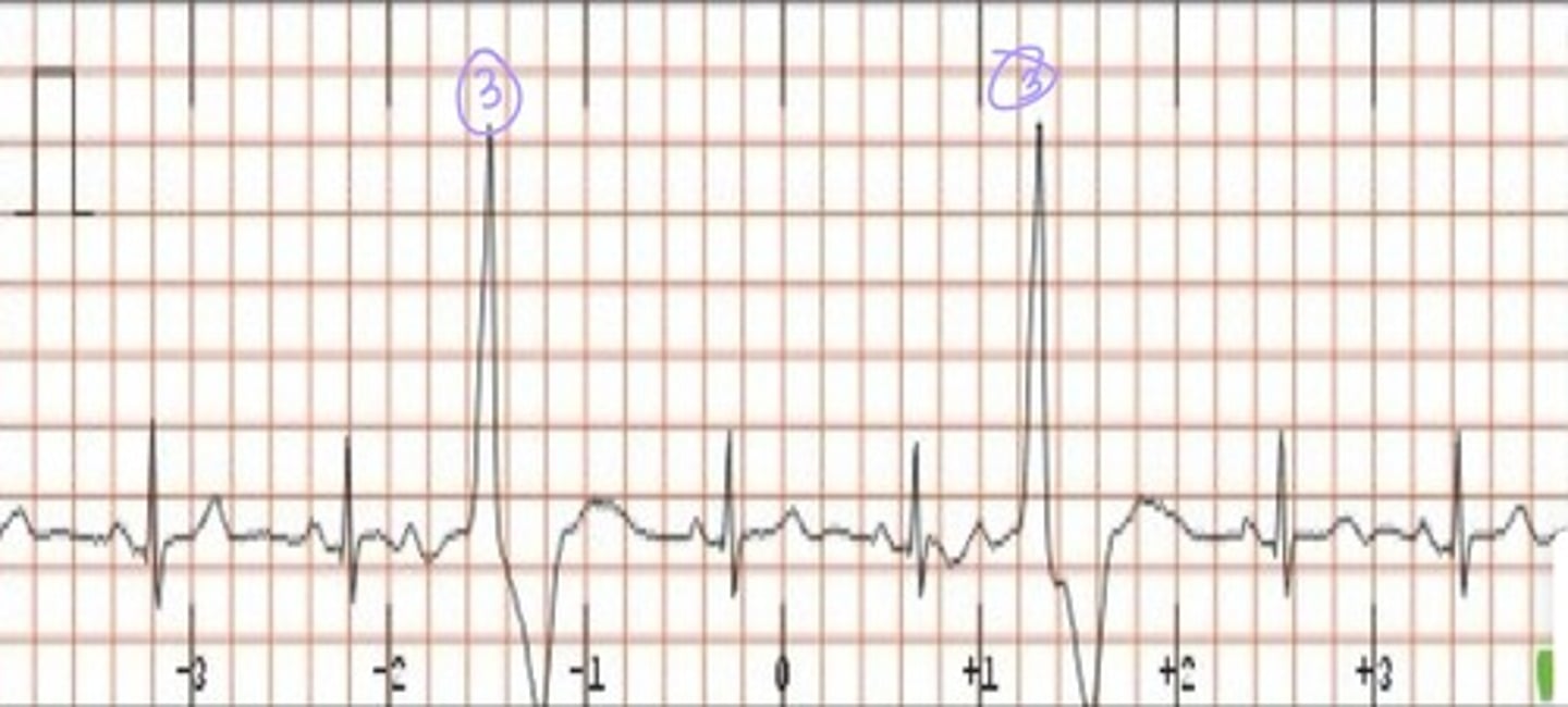 <p>What does the ECG show?</p>