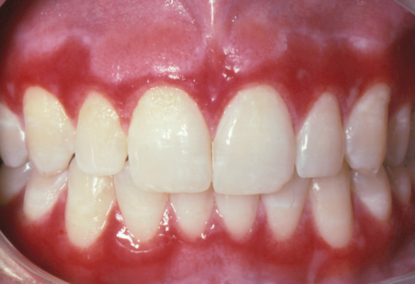 <p>Case 3. A 55-year-old woman presents with painful peeling gingiva. Gingiva is erythematous with sloughing epithelium. 3a. What is the term to describe the gingiva?</p>