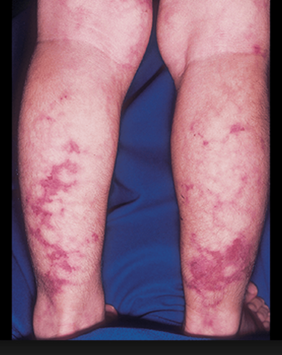 <p>Polyarteritis nodosa</p>
