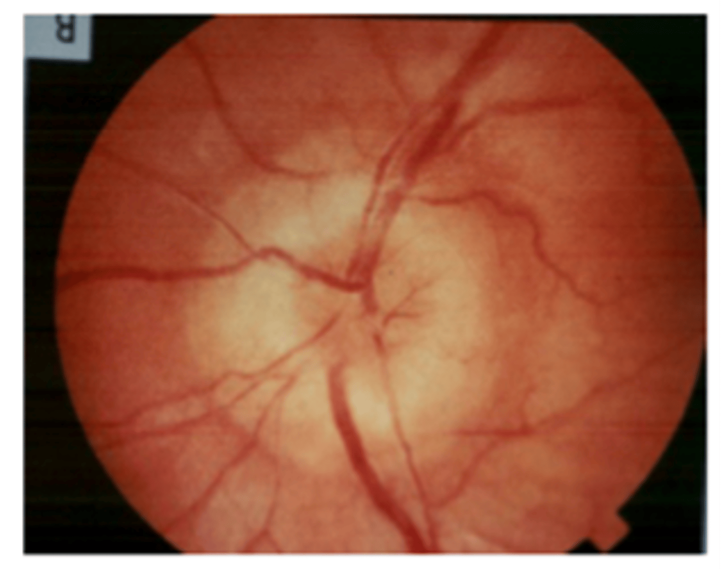 <p>swelling of the optic disc, seen in 75% of people with brain tumors</p>