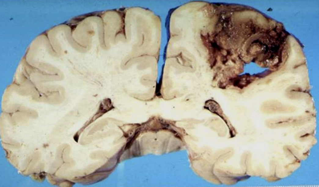 <p>Abscess</p>