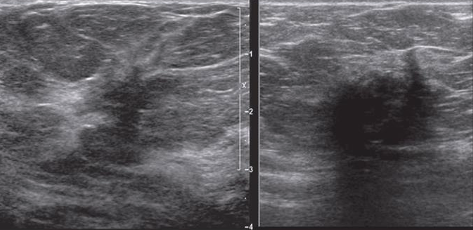 <p>higher rate of being multifocal, multicentric, and bilateral</p><p></p>