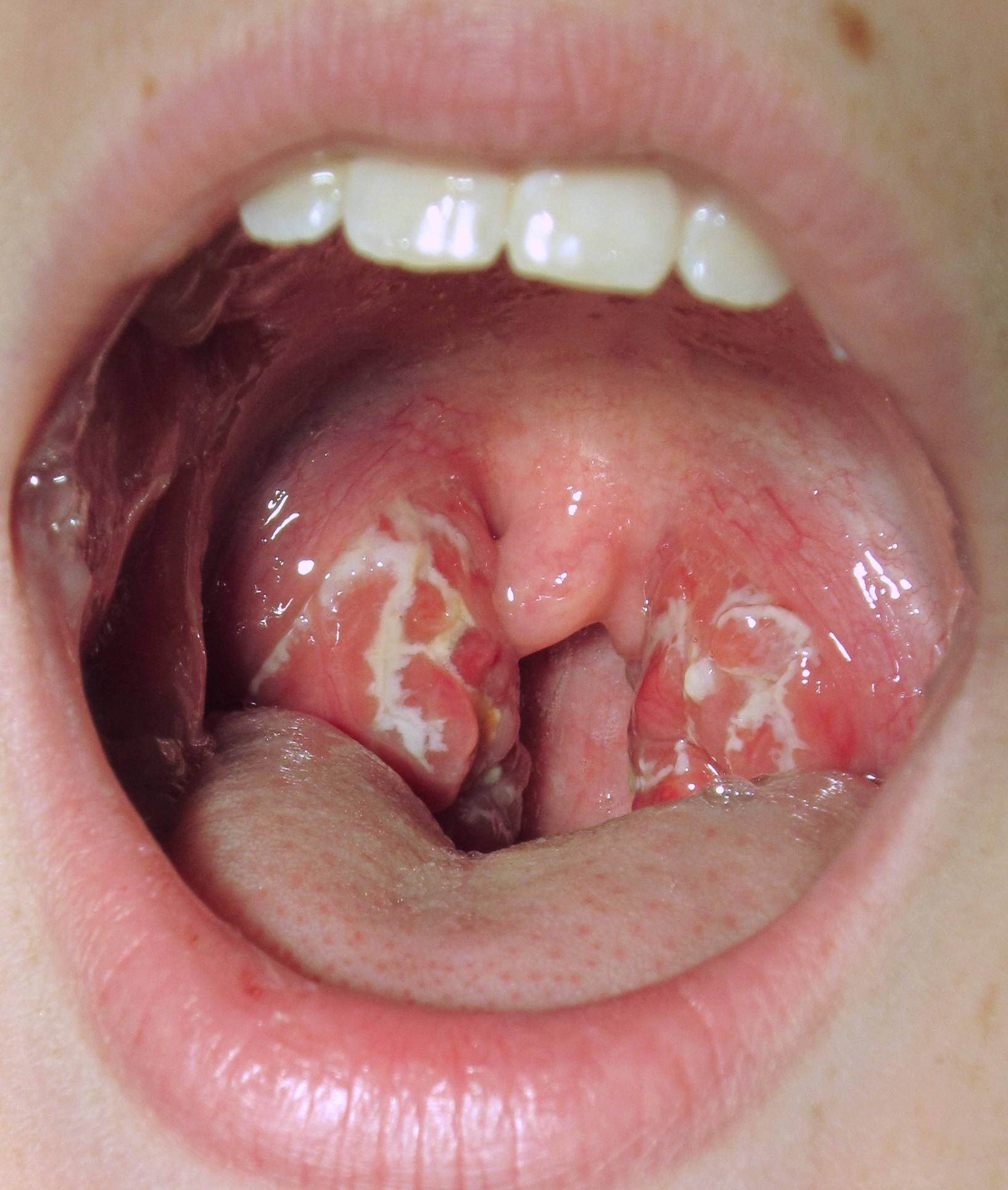 <p>red throat</p><p>thick+white exudate on tonsils</p><p>E: infectious mononucleosis<br>group A strep</p>