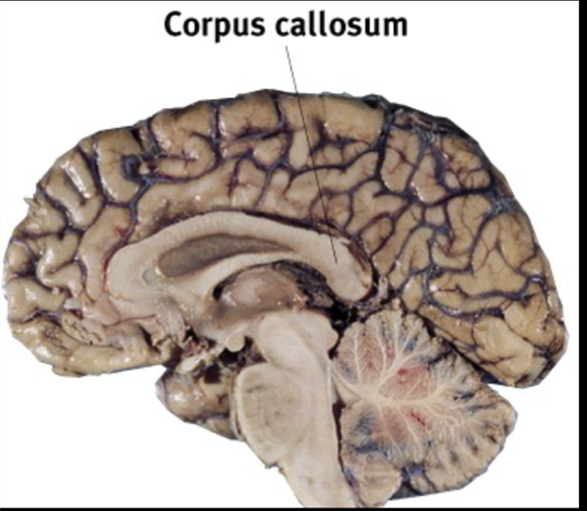 <p>The Corpus Callosum </p>