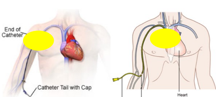 <p>midline vs PICC line vs Implanted port</p>
