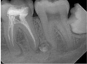 <p>A well-defined, localized radiopaque lesion on a radiograph. Example: condensing osteitis </p>