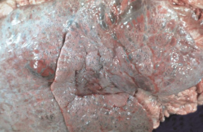 <p>Most common cause and 2 pathological findings of this </p>