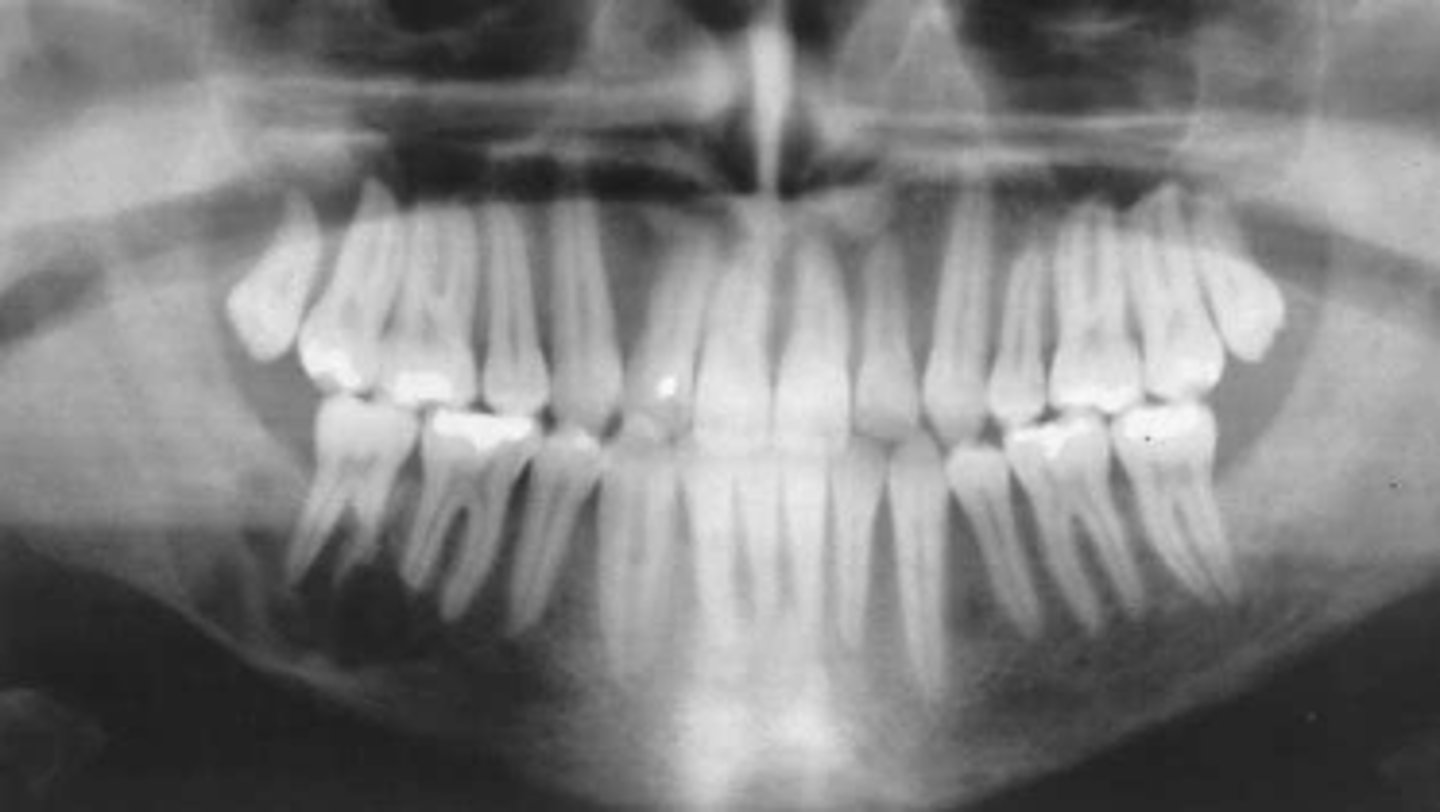 <p>This patient has hyperparathyroidism. What type of lesion is this?</p>