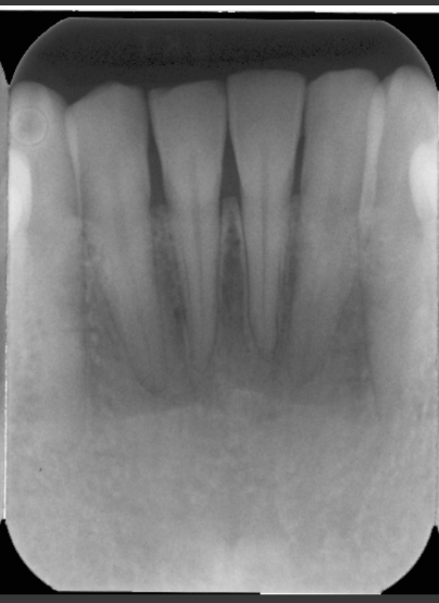 <p>A radiolucent area that site between the alveolar crest and mental ridge of the mandible. Usually surrounds the roots of the laterals and centrals.</p>