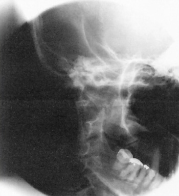 <p>What is this x-ray demonstrating?</p>