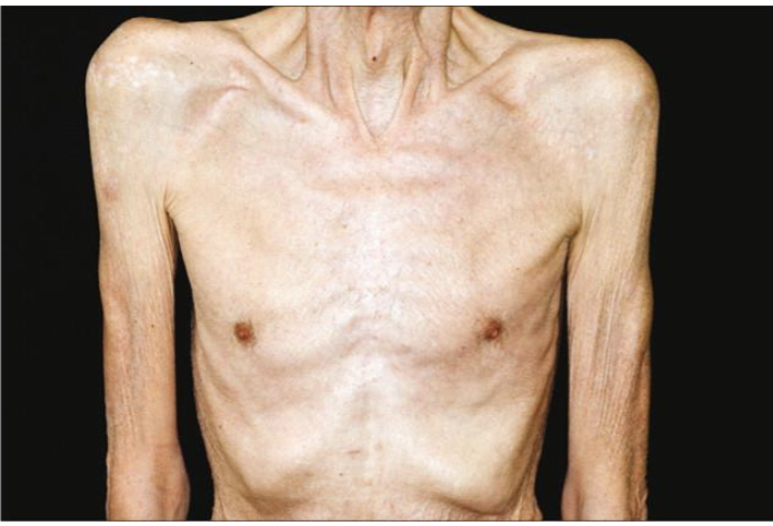 <p>Cachexia - metabolic wasting syndrome commonly in people with advanced cancer</p><ul><li><p>involuntary weight loss, including loss of fat and muscle, loss of appetite, weakness and fatigue</p></li><li><p>Not reversed by increase dietary intake</p></li><li><p>complex metablic state that involves increased breakdown of protein</p></li></ul><p></p>