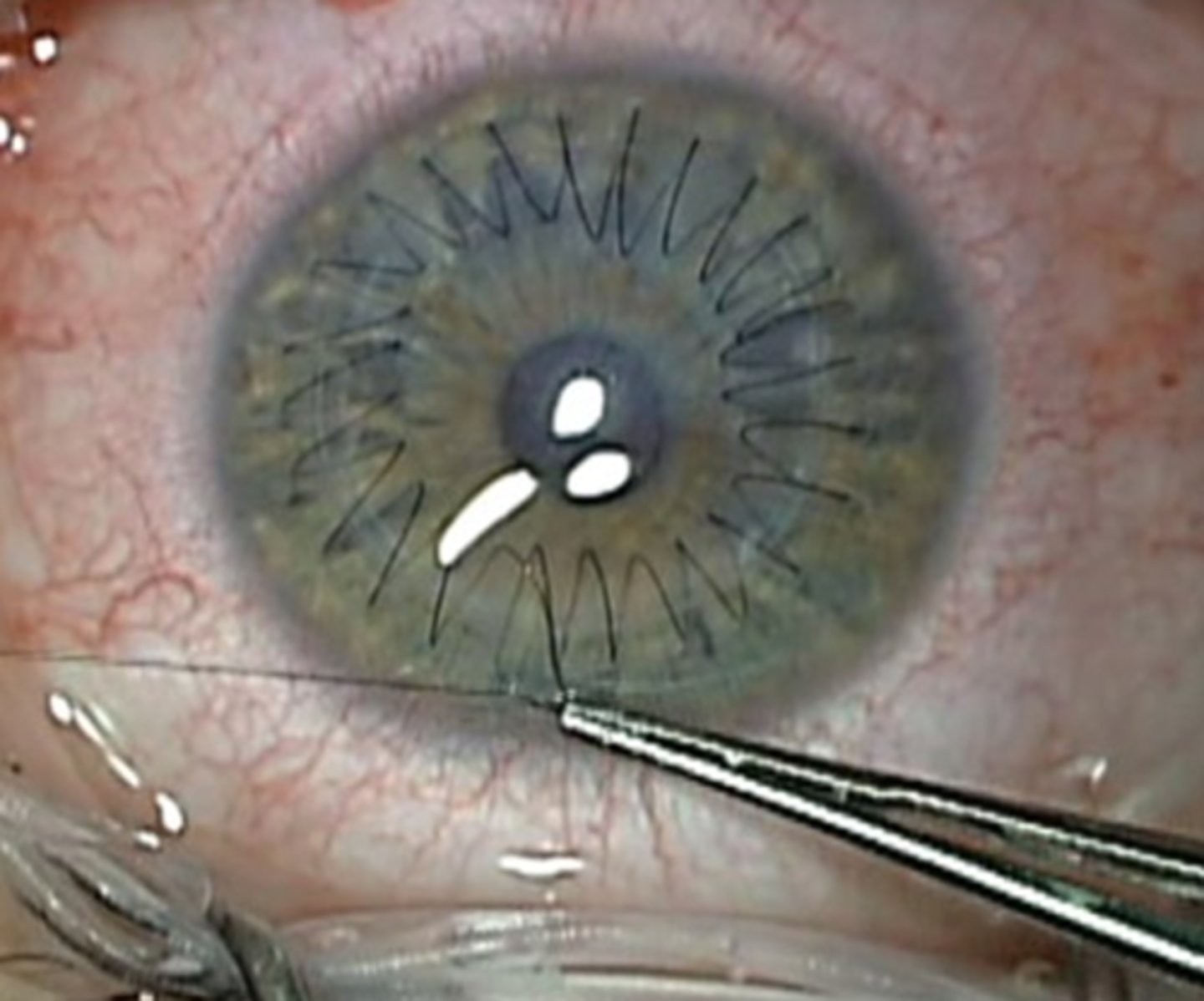 <p>What is the con of a continuous suture used in PKP?</p>