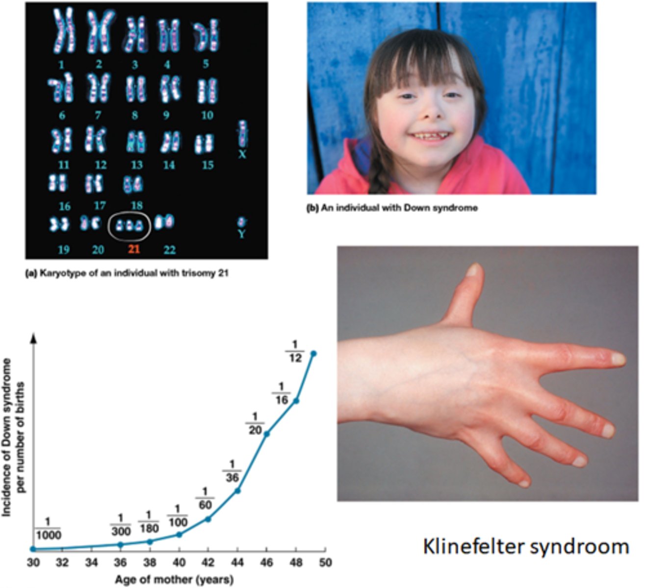 <p>- Trisomie 21: Down syndroom</p><p>- XXY: Klinefelter syndroom</p><p>- X: Turner syndroom</p>