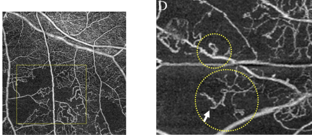 <p>irregular vascular network in superficial vascular complex slab</p><ul><li><p>shouldn’t see these vessels in vitreoretinal interface (IRMA doesn’t grow into vitreous)</p></li></ul><p></p>