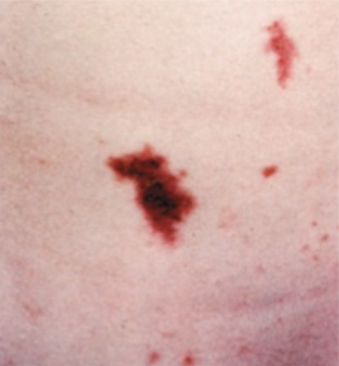 <p>Diagnosis: Meningitis &amp; petechiae (see image). Gram stain of CSF will confirm.</p><p>Treatment: Abx. Prophylactic treatment for close contacts</p>