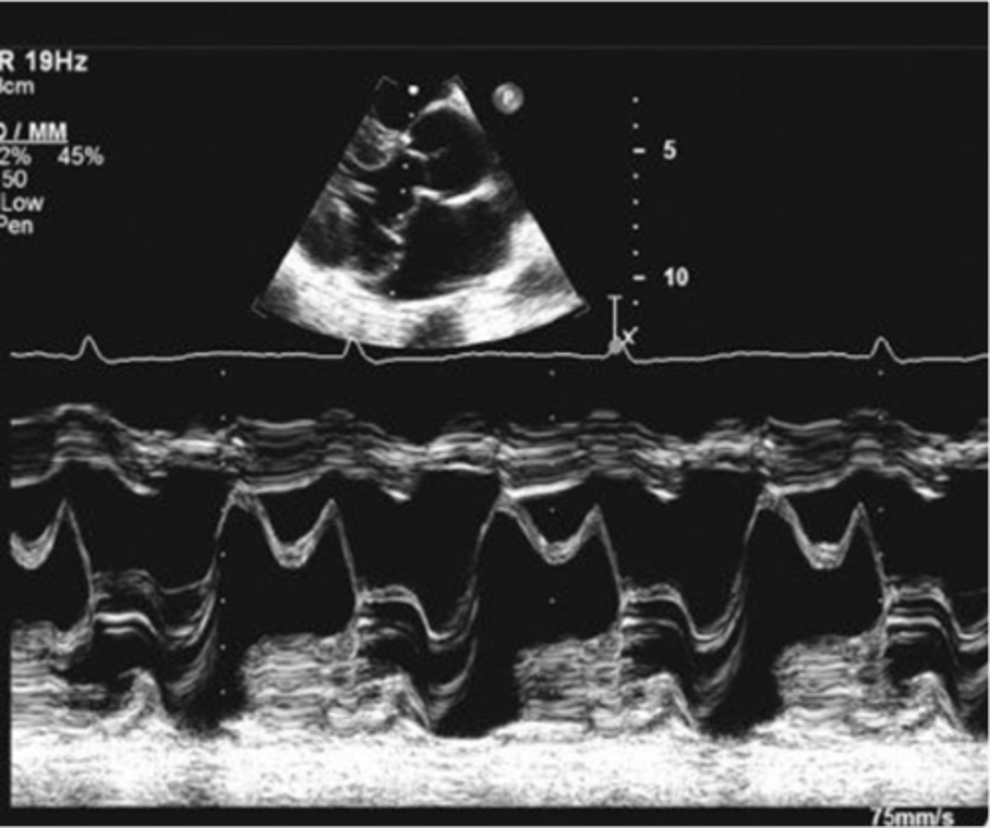 <p>posterior motion of MV leaflets beyond the MV annular plane during systole; hammocking appearance</p>