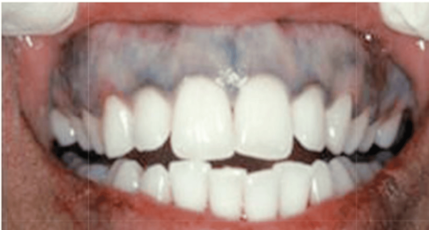 <p>What type of pigmented lesion?</p>