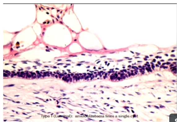 <p>Ameloblastoma lines a single cyst</p><p><span style="background-color: transparent;"><span>Cyst lining has ameloblasts. Stellate reticulum.&nbsp;</span></span></p><p><span style="background-color: transparent;"><span>Rather than having a follicular appearance has a cystic lining.</span></span></p>