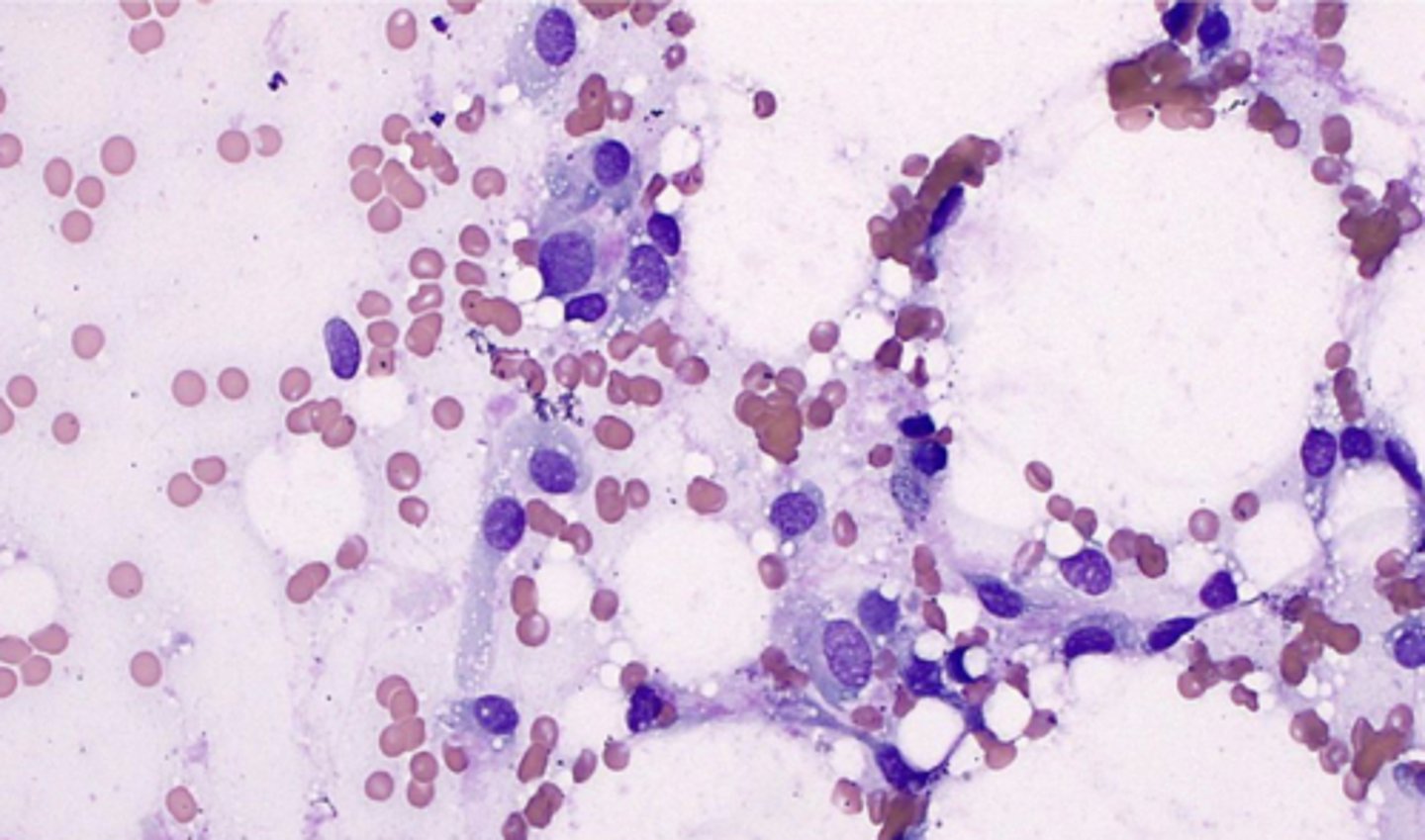 <p>You take an FNA from a dog with a firm, poorly circumscribed, adherent to the underlying tissue mass. </p><p>On the slide, you note plump, spindle cells with large nuclei, fat vacuoles in the cytoplasm. </p><p>What is your top differential?</p>