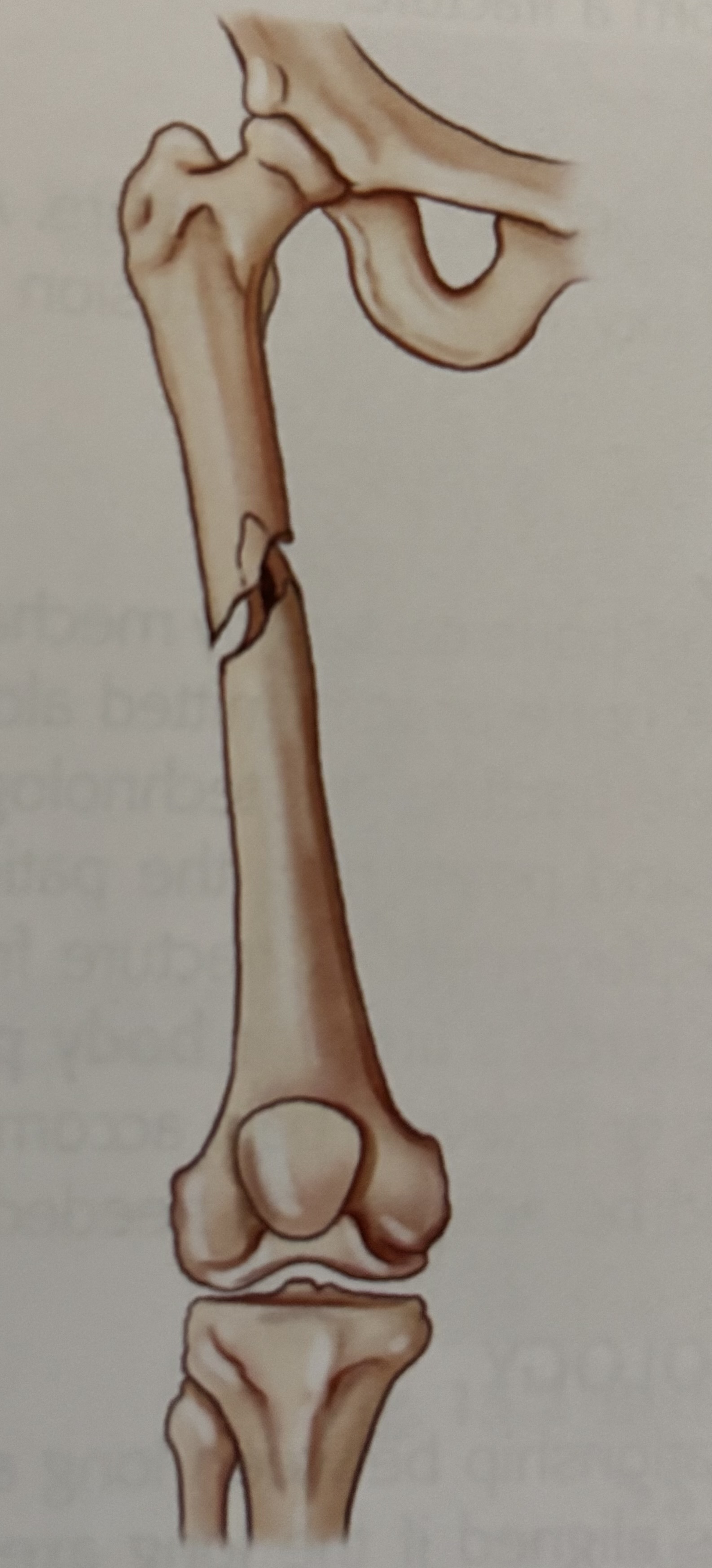 <p>What type of fracture is this?</p>