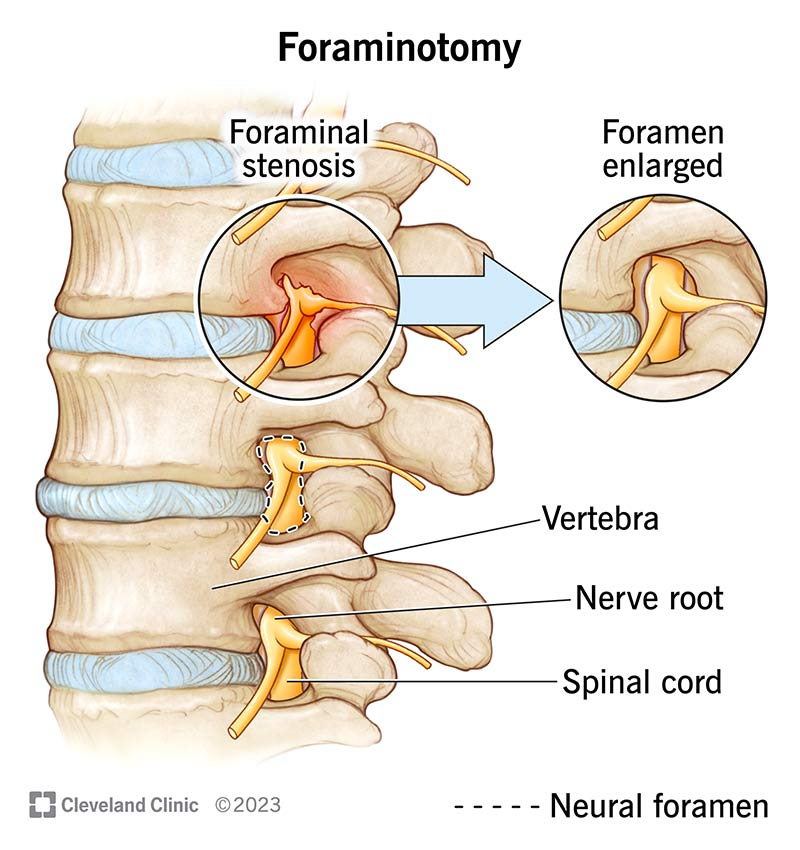 <p><strong>Neuroforamen</strong></p><p>Hard to tell from other picture, but its a foramen where the neurons come out of&nbsp;</p>