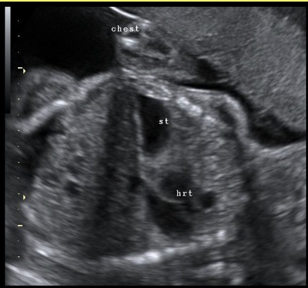 <p>what is the most common cause for a shift of cardiac axis/position</p><p>a) diaphragmatic hernia</p><p>b) ectopia cordis</p><p>c) congenital cystic adenomatoid malformation</p><p>d) chromosomal anomalies </p>