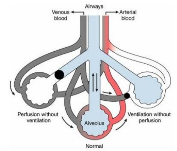 <ul><li><p><strong>Left</strong></p></li><li><p>Good ventilation</p></li><li><p>No CO2 reaches</p></li><li><p>No perfusion (blood flow) to the alveoli</p></li></ul><p><strong>V/Q &gt; 1</strong></p>