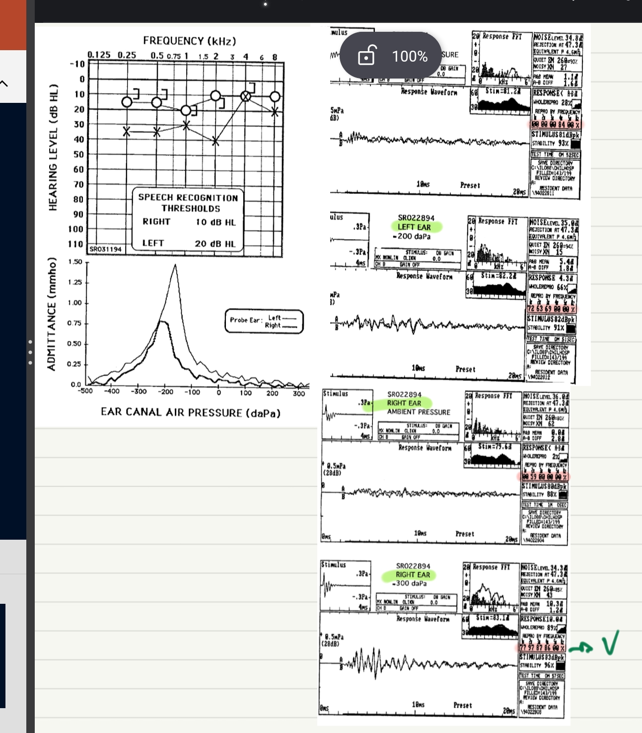 <ul><li><p>type C rechts → neg druk → ingetrokken tympanogram</p></li><li><p>Rechts audiogram ok</p></li><li><p>links audiogram conductief → dus slechte emissies</p></li><li><p>→ emissies g WANT in frequentieband reproduceerbaarheid &lt;60%!!</p></li><li><p>maar normaal gehoor rechts op audiogram</p></li><li><p>= negatieve midenoordruk</p></li></ul><p> bij otitis media no erger = echt geen emisiies meer</p>