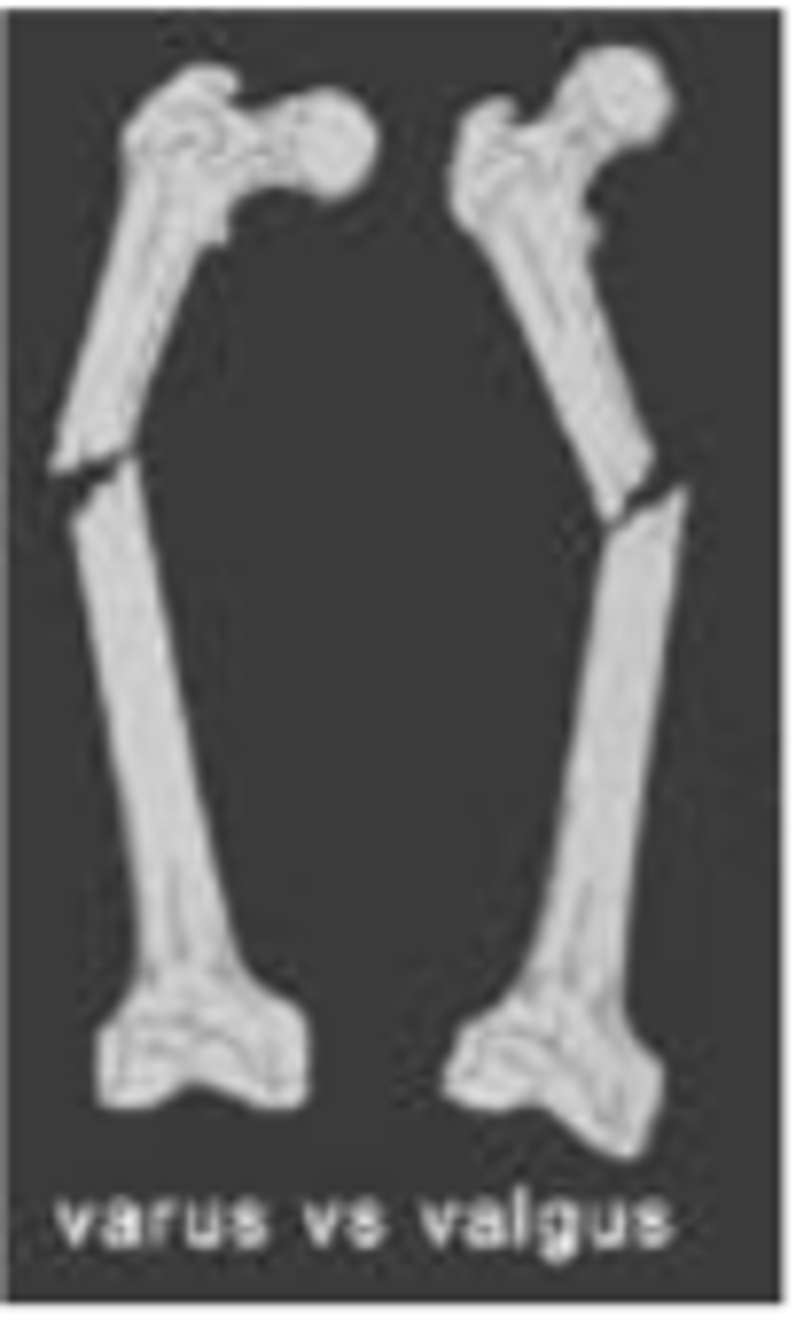 <p>distal part of distal fragments angled TOWARD midline w/ apex angled AWAY from midline</p>