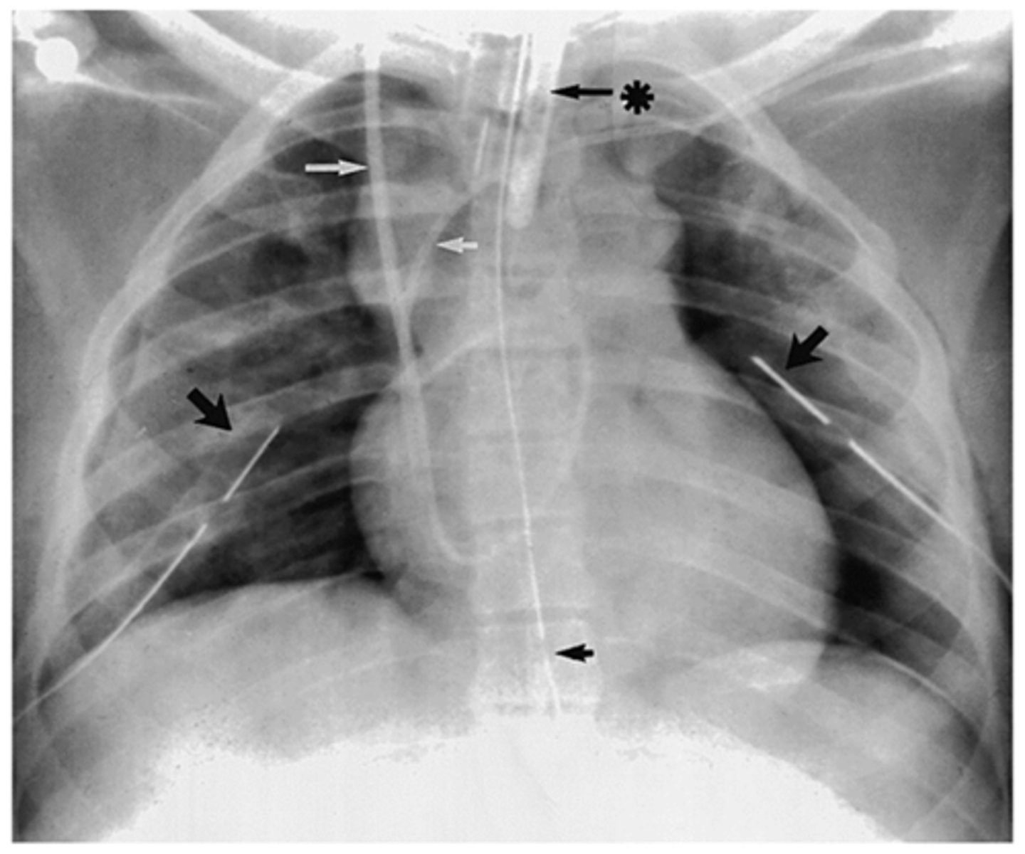 <p>What is goin going on in this CXR?</p>