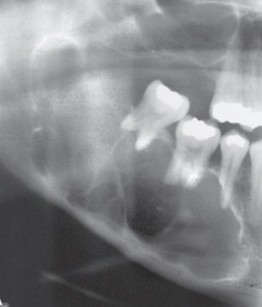 <ul><li><p>Well-defined, corticated borders</p></li><li><p>Maxilla can be more ill-defined</p></li></ul><p></p>