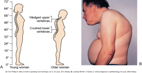 <ul><li><p>Occurs most commonly in spine, hips, and wrists</p></li><li><p>Common manifestations</p><ul><li><p>Stooped posture</p></li><li><p>Joint pain</p></li><li><p>Bone pain and tenderness</p></li><li><p>Back pain (early manifestation)</p></li><li><p>Bone fractures (early manifestation)</p></li></ul></li><li><p>Gradual loss of height</p></li><li><p>Kyphosis </p><ul><li><p>“Dowager’s Hump”</p></li></ul></li></ul><p></p>