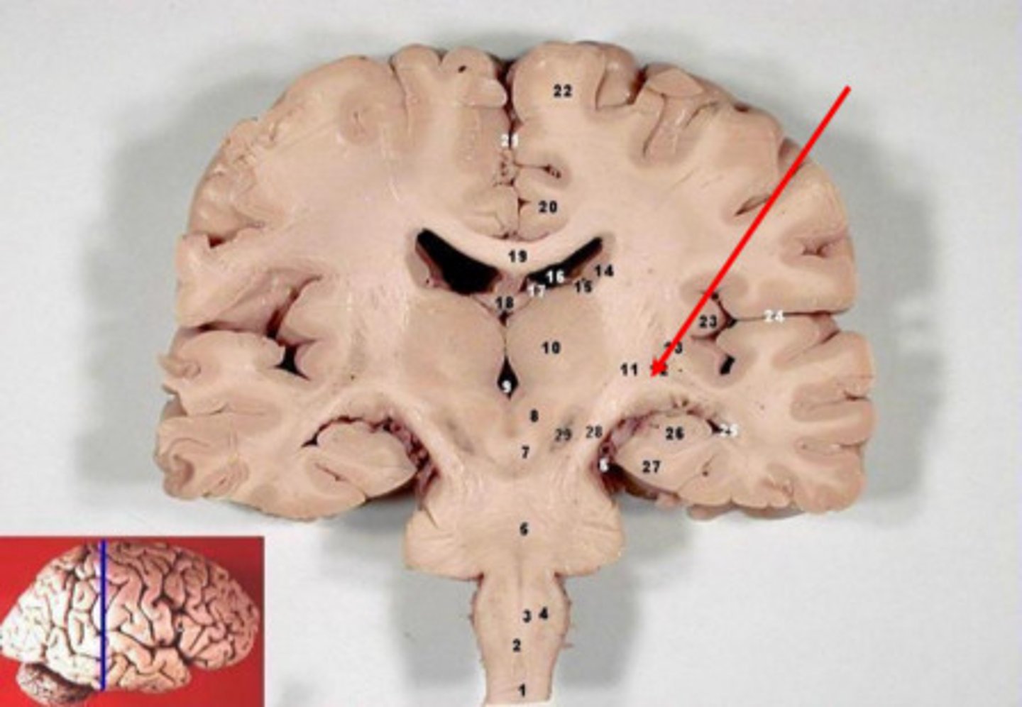 <p>Myelinated axons.<br><br>It is deep to the cortex.</p>