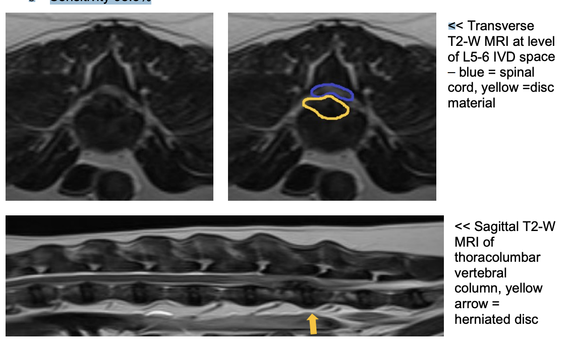 <p>Gold standard o Can differentiate anatomical structures of vertebral column better to CT, including supporting ligamentous structures, synovial joints, bone marrow, nerve roots, spinal cord parenchyma, cerebrospinal fluid, epidural fat and the layers of the intervertebral disc o Characteristics of IVDE include extradural compression of the spinal cord centred over or near the intervertebral disc space <span data-name="black_small_square" data-type="emoji">▪</span> Compression and/or displacement of the spinal cord = displacement or loss of the hyperintense (white/bright) signal associated with subarachnoid and epidural spaces on T2W images <span data-name="black_small_square" data-type="emoji">▪</span> Extruded nucleus pulposus typically = hypointense (black/dark) mass within the epidural space on T2W images o Requires GA whereas CT can be done under sedation o Sensitivity 98.5% </p>