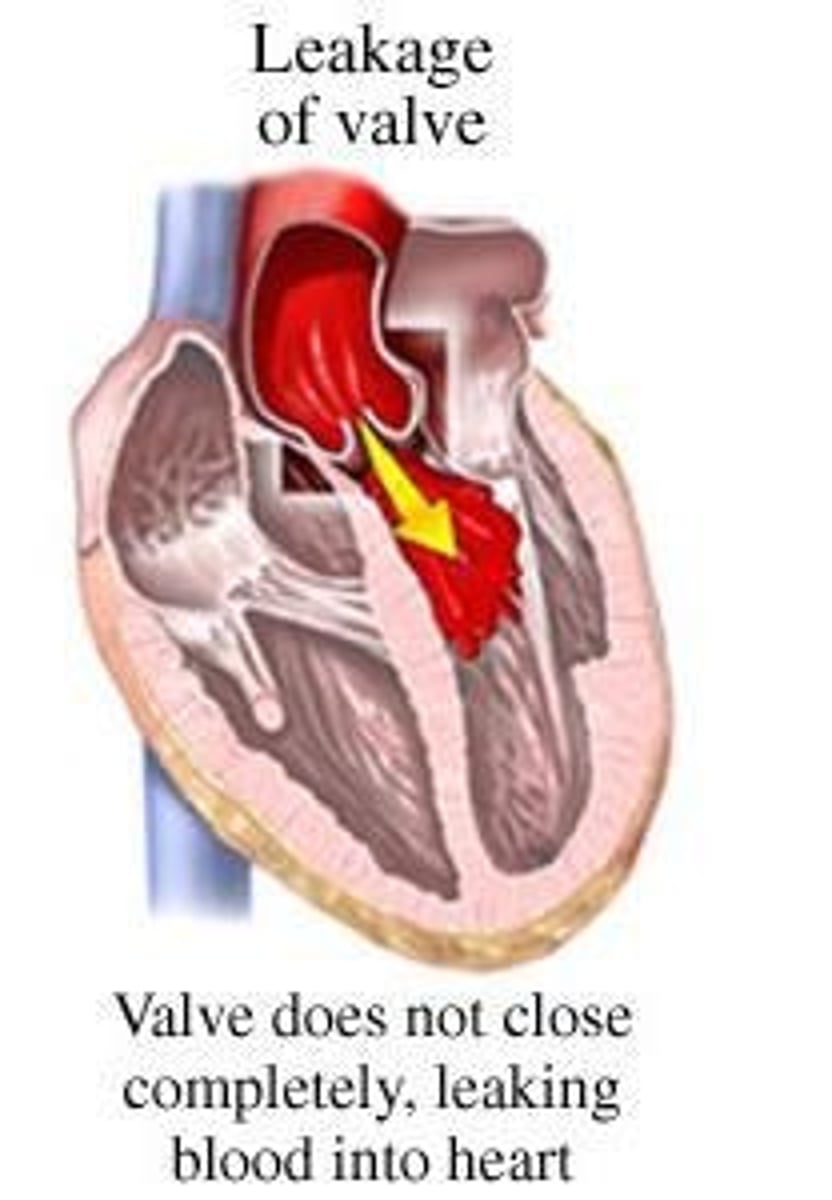 <p>-incomplete closure of a valve, allowing blood to leak backward</p><p>-bidirectional blood flow</p><p>-decreases cardiac output and increases workload on the heart which causes hypertrophy</p><p>-causes dilation of the ventricles</p>