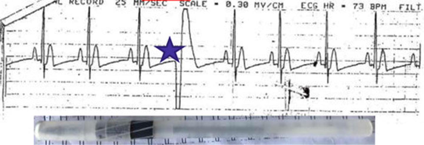 <p>What is the arrhythmia?</p>