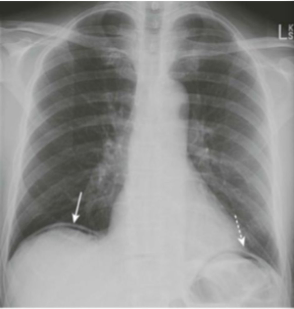 <p>air in peritoneal cavity, caused by rupture of an air-containing loop of bowel, trauma, or abdominal surgery (5-7 days post op)</p><p>1. air beneath diaphragm</p><p>2. rigler sign- visualization of both sides of bowel wall</p><p>3. visualization of falciform ligament</p>
