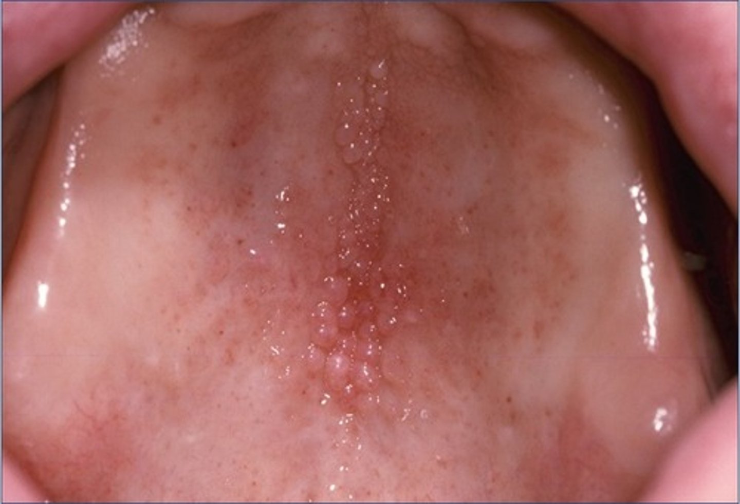 <p>• Usually occurs on the hard</p><p>palate beneath a denture base</p><p>• Usually asymptomatic</p><p>• Mucosa is erythematous and has</p><p>a pebbly or papillary surface</p>