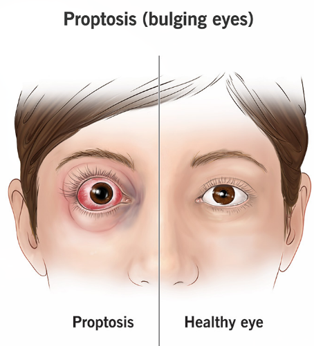 <p>term. Proptosis </p>