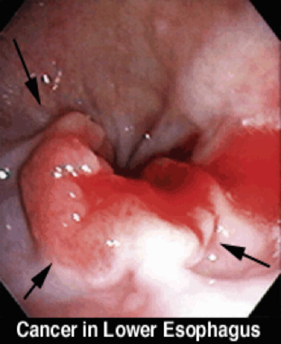 <p>Adenocarcinoma</p>