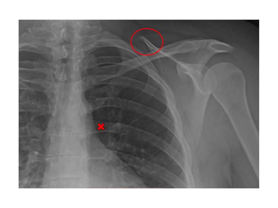 <p>What structure of the scapula is within the red circle?</p>