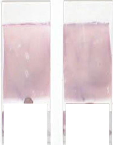 <p>What is this blood film appearance, and what is the cause/solution?</p>
