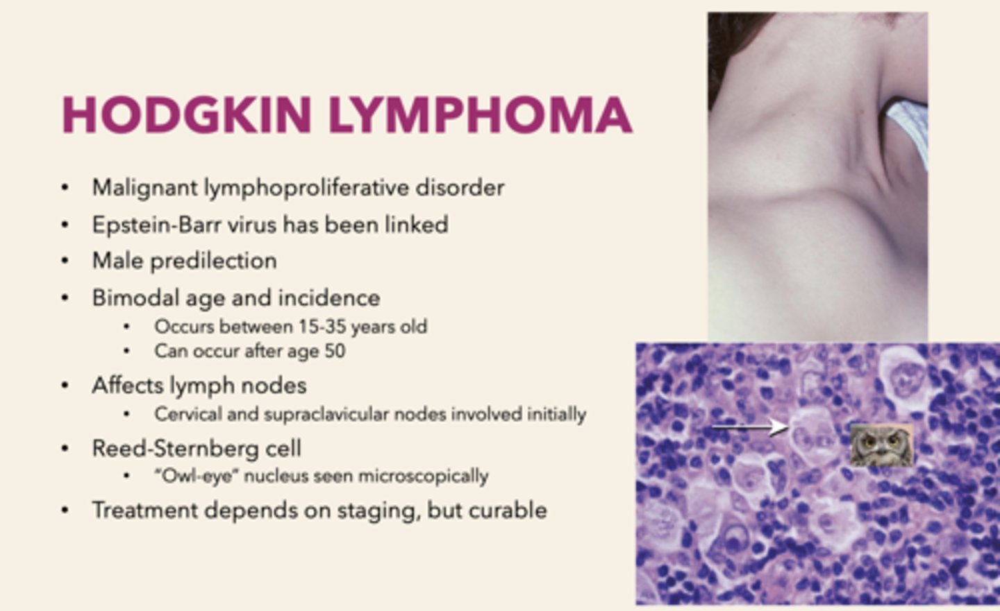 <p>Hodgkin's Lymphoma</p>