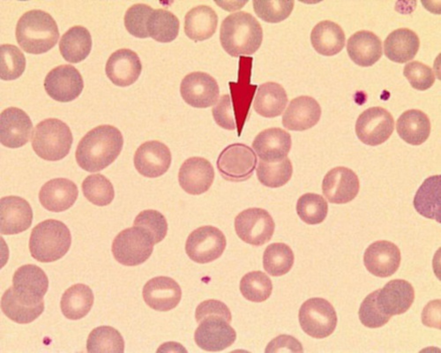 <p>- Fine red/violet ring structure</p><p>- Arg - rich histones w iron (rare occurence)</p><p>- Etiologies: megaloblsstic anemias, metal poisoning</p>