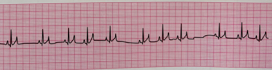 <p><span>The&nbsp;_______&nbsp;arrhythmia is common under anesthesia for dogs. It is characterized by longer than normal spaces between QRS complexes and corresponds with breathing. Please name the arrhythmia shown below.</span></p>